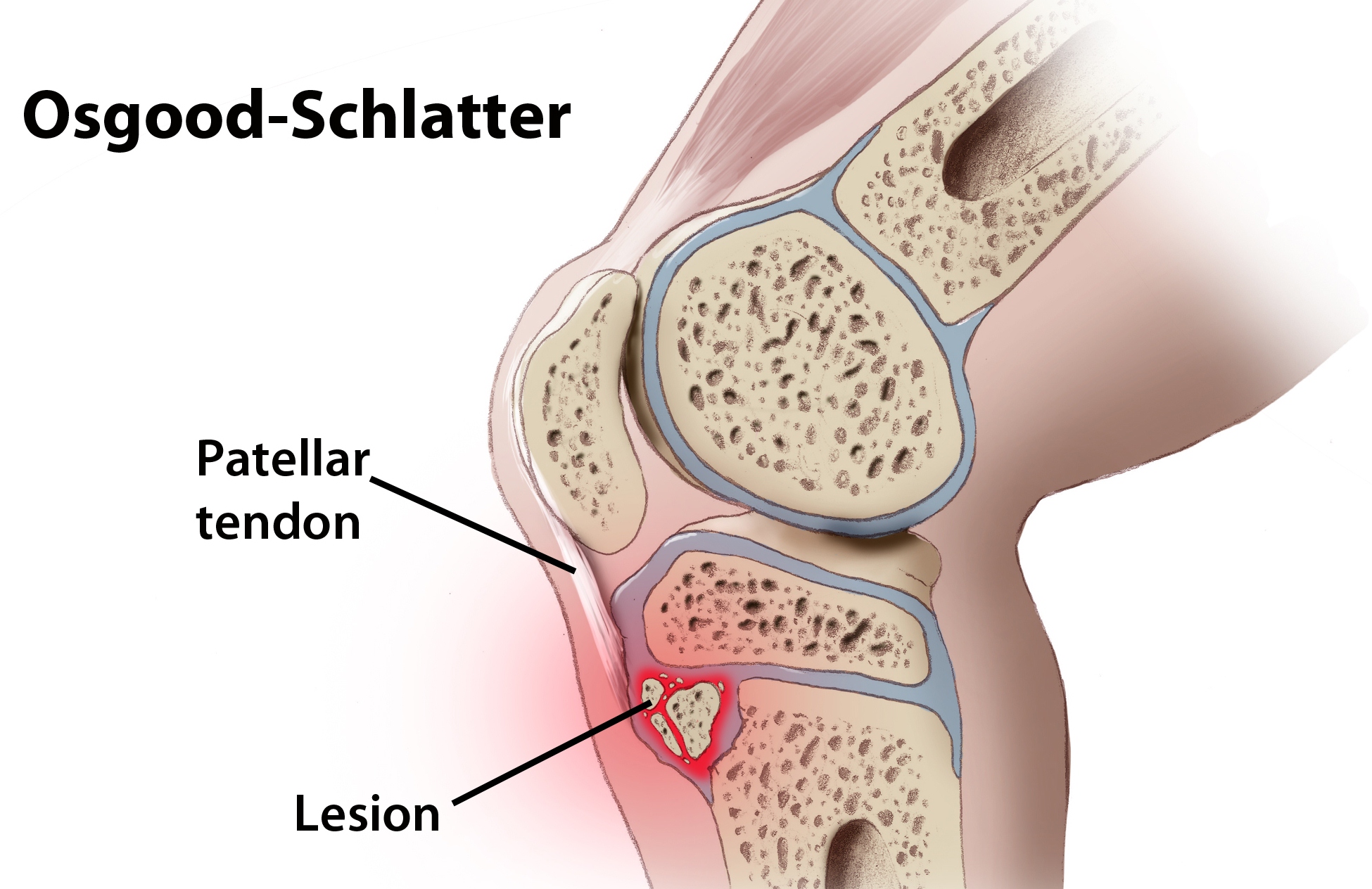 Osgood Schlatters Disease Elite Podiatry