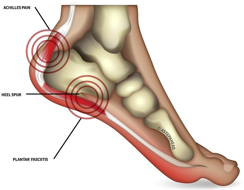 Outer Heel Pain | Causes, Symptoms, Treatment | Sydney Heel Pain