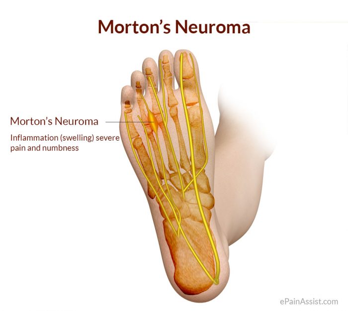 Mortons Neuroma Elite Podiatry